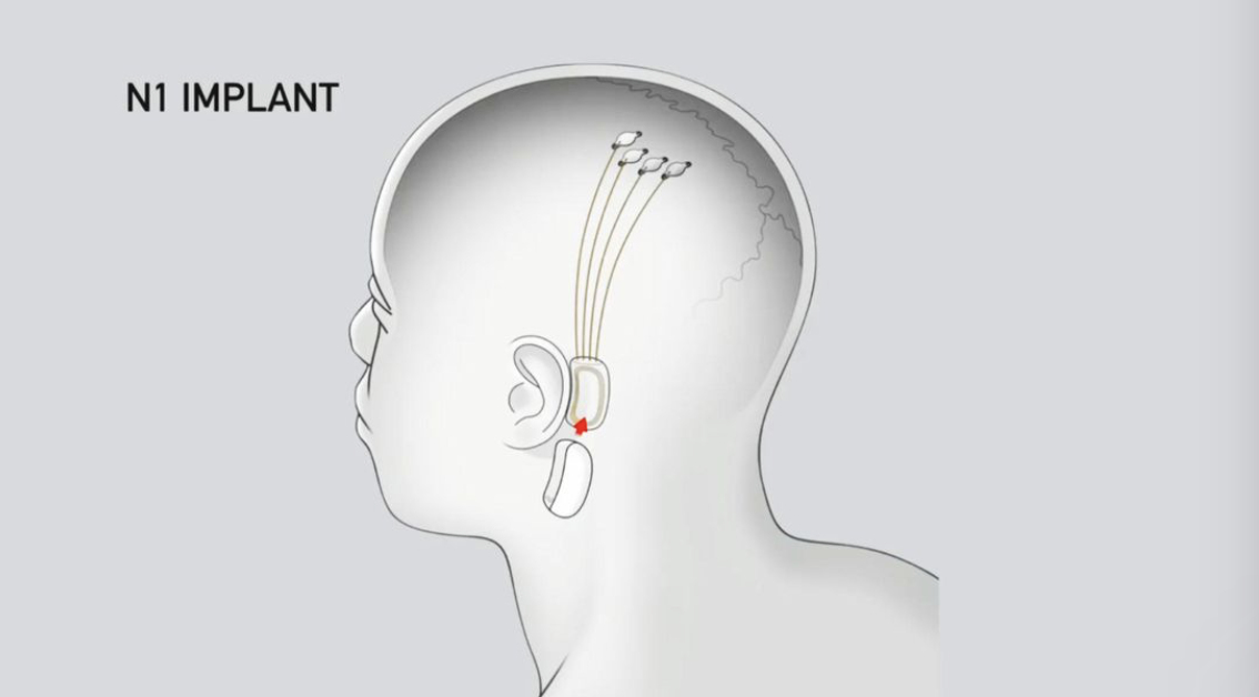 马斯克：脑机接口技术将有重大升级 最早今年投入应用